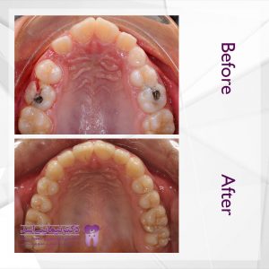 نمونه ارتودنسی ثابت شماره 72