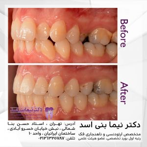 نمونه ارتودنسی ثابت شماره 75