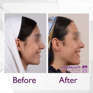 نمونه ارتودنسی ثابت شماره 74