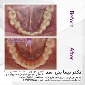 نمونه ارتودنسی ثابت شماره 76