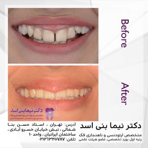 نمونه ارتودنسی ثابت شماره 76