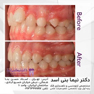 نمونه ارتودنسی ثابت شماره 79