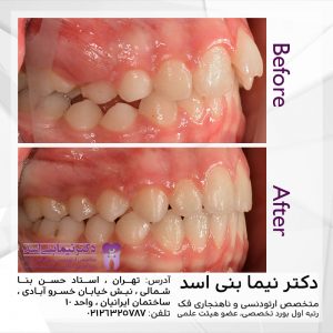 نمونه ارتودنسی ثابت شماره 79