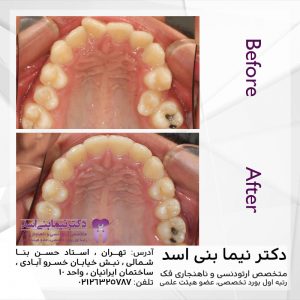 نمونه ارتودنسی ثابت شماره 77