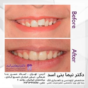 نمونه ارتودنسی ثابت شماره 79