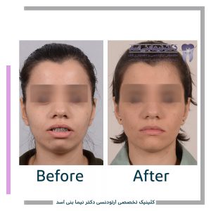 نمونه ارتودنسی ثابت شماره 88