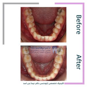 نمونه ارتودنسی ثابت شماره 89