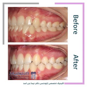 نمونه ارتودنسی ثابت شماره 89