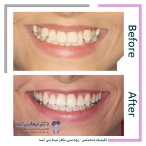 نمونه ارتودنسی ثابت شماره 85