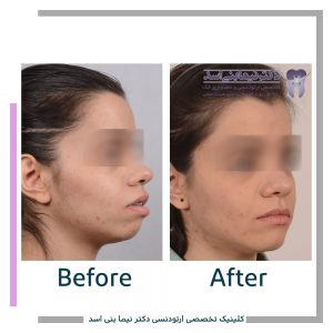 نمونه ارتودنسی ثابت شماره 88