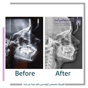 نمونه ارتودنسی ثابت شماره 88