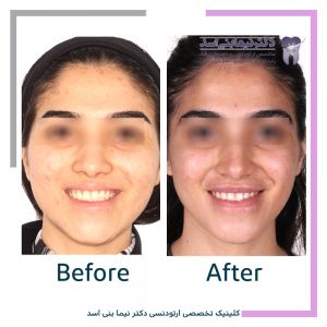 نمونه ارتودنسی ثابت شماره 89