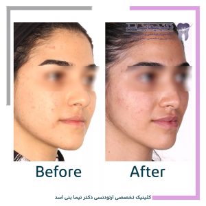 نمونه ارتودنسی ثابت شماره 89
