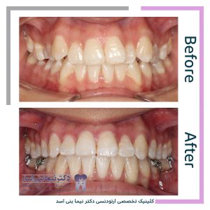 نمونه ارتودنسی ثابت شماره 85