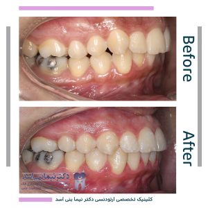 نمونه ارتودنسی ثابت شماره 82