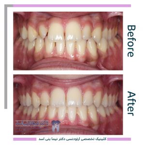 نمونه ارتودنسی ثابت شماره 83