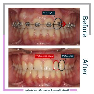 نمونه ارتودنسی ثابت شماره 84