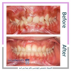 نمونه ارتودنسی ثابت شماره 87