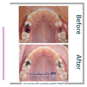 نمونه ارتودنسی ثابت شماره 88