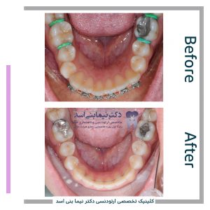 نمونه ارتودنسی ثابت شماره 88