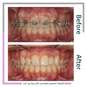 نمونه ارتودنسی ثابت شماره 84