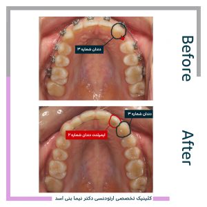 نمونه ارتودنسی ثابت شماره 84