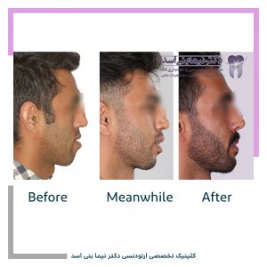 نمونه ارتودنسی ثابت شماره 86