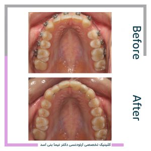 نمونه ارتودنسی ثابت شماره 84
