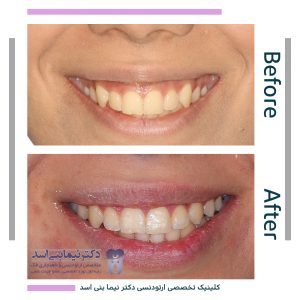 نمونه ارتودنسی ثابت شماره 82