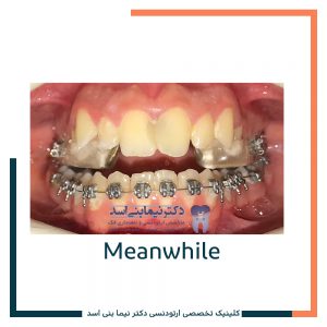 نمونه ارتودنسی ثابت شماره 80