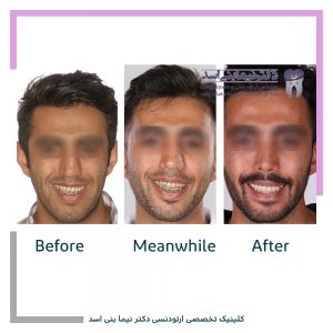 نمونه ارتودنسی ثابت شماره 86