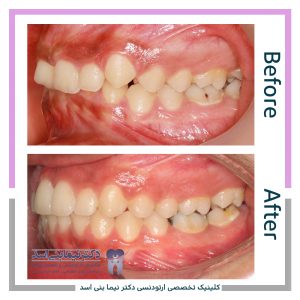 نمونه ارتودنسی ثابت شماره 87