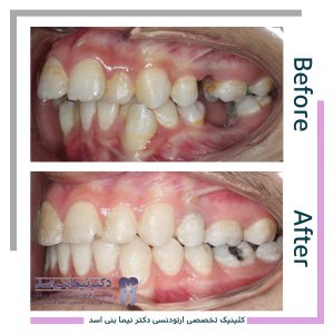 نمونه ارتودنسی ثابت شماره 81