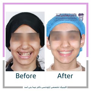 نمونه ارتودنسی ثابت شماره 87