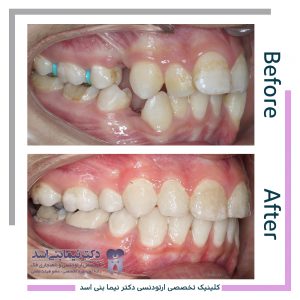 نمونه ارتودنسی ثابت شماره 81