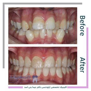 نمونه ارتودنسی ثابت شماره 81