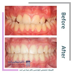 نمونه ارتودنسی ثابت شماره 94