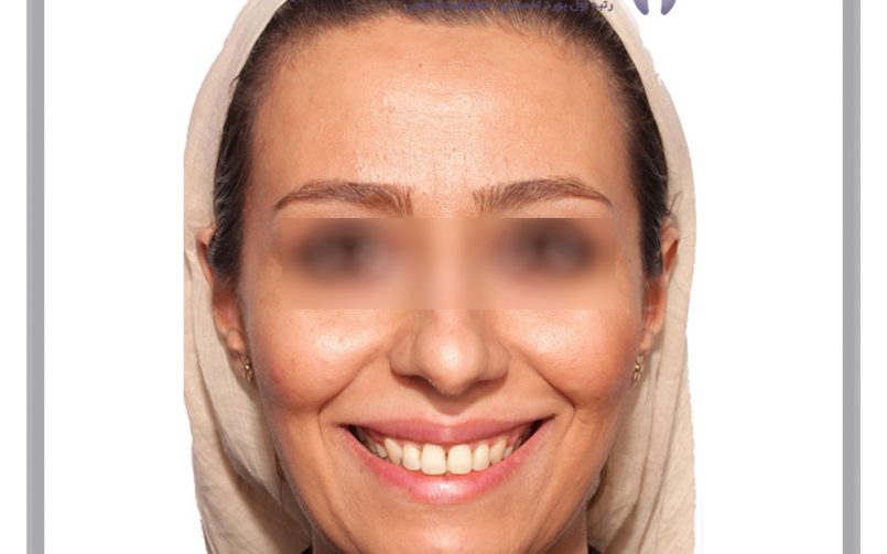 نمونه ارتودنسی ثابت شماره 91