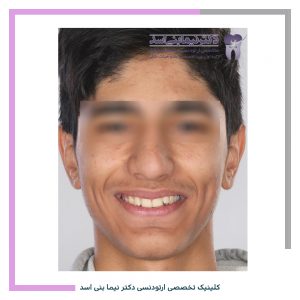 نمونه ارتودنسی ثابت شماره 96
