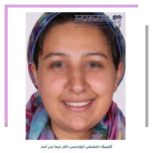 نمونه ارتودنسی ثابت شماره 97