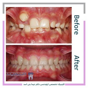 نمونه ارتودنسی ثابت شماره 100