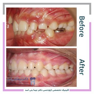 نمونه ارتودنسی ثابت شماره 100