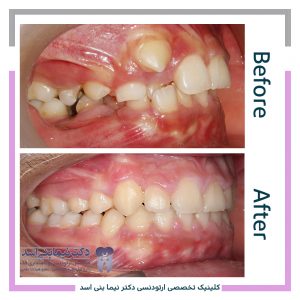 نمونه ارتودنسی ثابت شماره 100