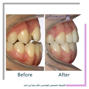نمونه ارتودنسی ثابت شماره 101