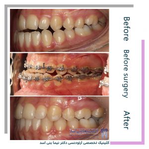 نمونه ارتودنسی ثابت شماره 101