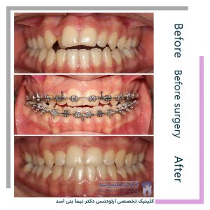 نمونه ارتودنسی ثابت شماره 101
