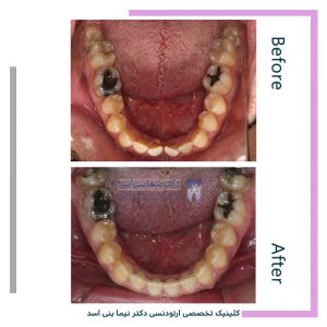 نمونه ارتودنسی ثابت شماره 102