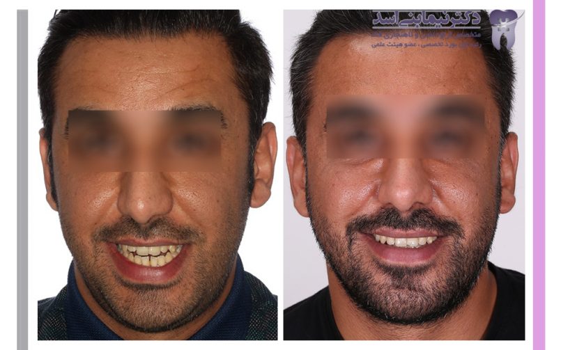 نمونه ارتودنسی ثابت شماره 102