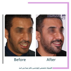 نمونه ارتودنسی ثابت شماره 102