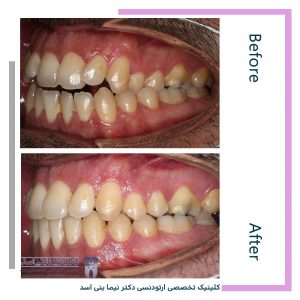 نمونه ارتودنسی ثابت شماره 102